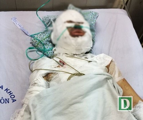 Hà Nội: Điều tra nghi án nữ thợ may bị bạn trai ngoại quốc tưới xăng đốt