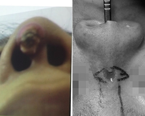 Thủng mũi, lõm má, biến dạng mí mắt vì ham làm đẹp giá rẻ dịp Tết