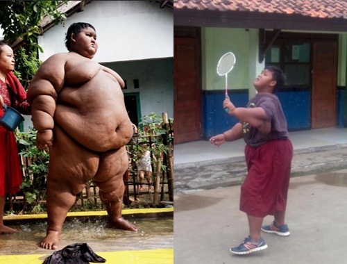 Bất ngờ với hình ảnh cậu bé nặng nhất thế giới sau khi giảm cân thành công