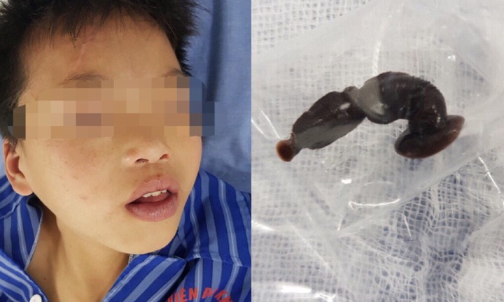 Rùng mình gắp con đỉa sống dài 6cm trong cổ họng bệnh nhi 13 tuổi