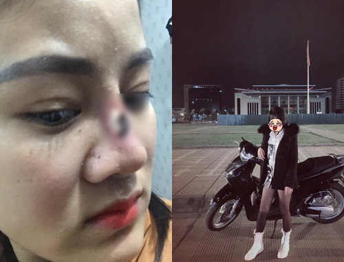 Cô gái trẻ 'ôm mũi hỏng' đến bắt đền chủ spa 17 tuổi gây xôn xao