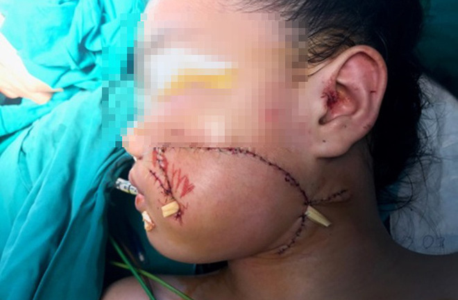 Chơi đùa với chó nhà nuôi, bé gái 8 tuổi bị cắn rách mặt