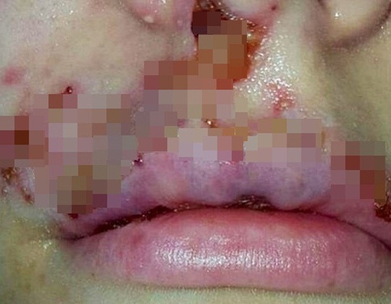 Cô gái trẻ trả giá đắt sau khi tiêm chất làm đầy môi