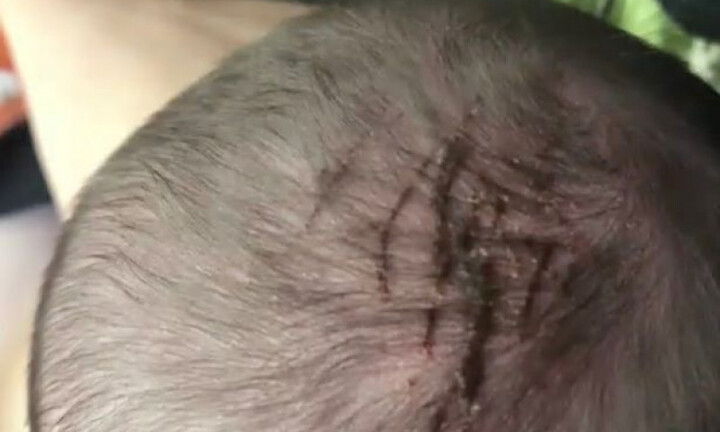 Chọc cho túi ối vỡ, không ngờ chọc vào đầu bé sơ sinh trong bụng