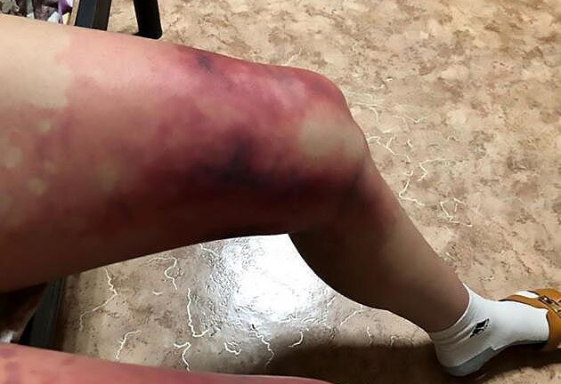 Nữ sinh nhập viện cấp cứu vì diện váy ngắn giữa trời tuyết âm 40 độ C