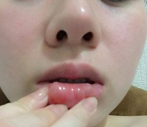 Sợ phẫu thuật, cô gái trẻ chọn tiêm filler tạo môi trái tim, nào ngờ đến cười cũng không dám