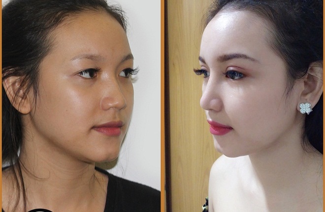 “Ăn gian” vài tuổi nhờ thực hiện combo thẩm mỹ