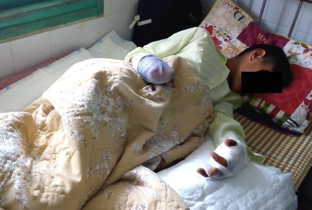 Đi cạo diêm thuê để làm pháo, cháu bé bị mất 6 ngón tay