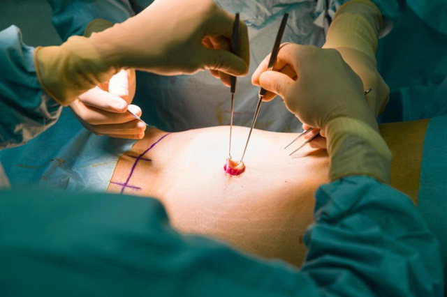 Không phải nâng mũi, độn cằm... phẫu thuật thẩm mỹ rốn mới là trào lưu của phái đẹp