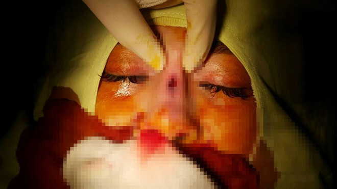 Nâng mũi giá rẻ, cô gái trẻ bị thủng sống mũi, hoại tử da