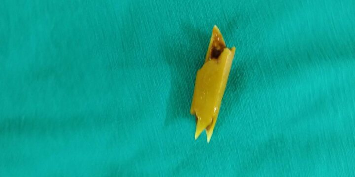 Xương gà chọc thủng ruột non: Bệnh nhân được cứu sống