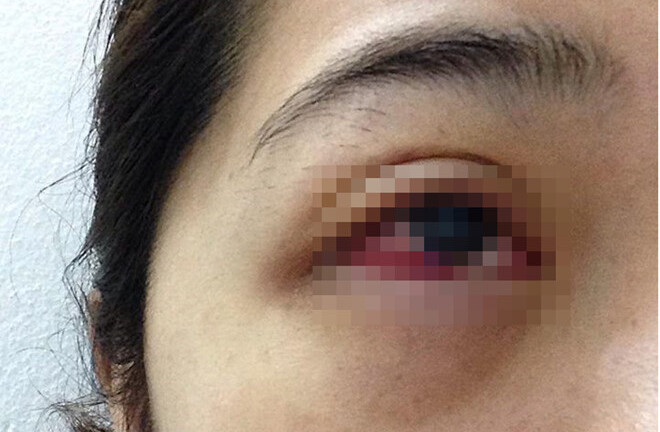 Cô gái trẻ tụ máu, nhiễm trùng mắt sau khi nối mi giả