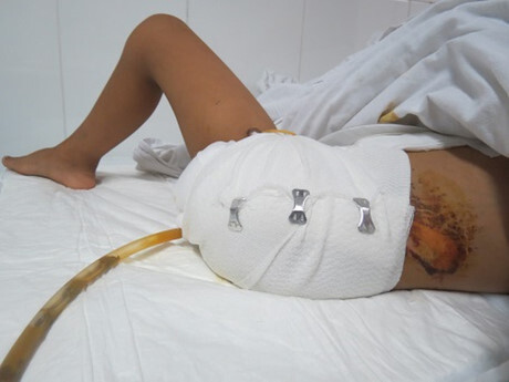 Cắt chân sau khi bỏ viện về chữa thầy lang