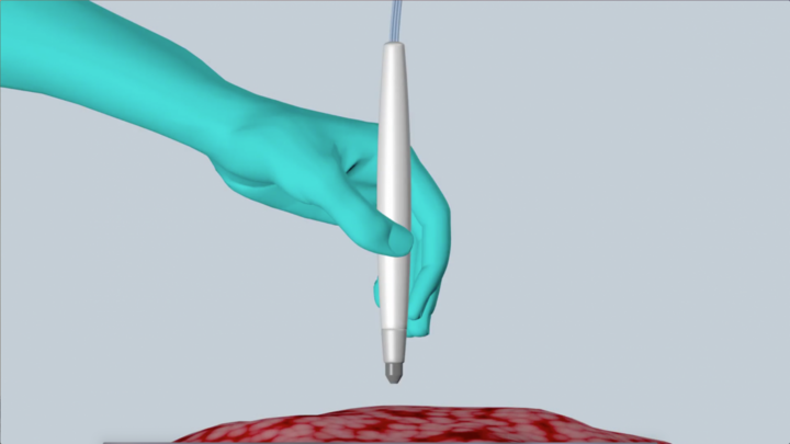 Cận cảnh chiếc bút chẩn đoán ung thư trong 10 giây