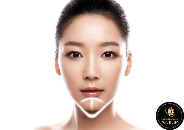 Giải quyết cằm ngắn lẹm chỉ trong 45 phút
