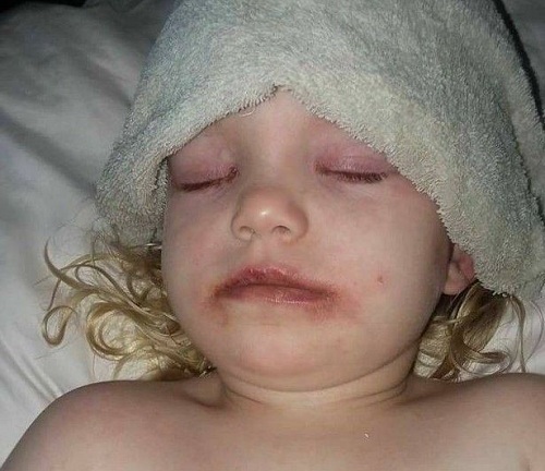 Bà mẹ kinh hãi chia sẻ hình ảnh của con gái 3 tuổi bị phồng rộp do dị ứng với đồ trang điểm rẻ tiền