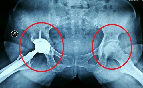 Nhiều người tự làm mình tàn phế mà không hay biết