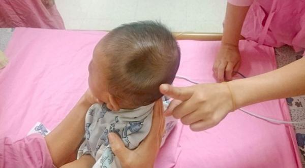 Bé 4 tháng tuổi bị lõm đầu do thói quen 90% cha mẹ Việt mắc phải