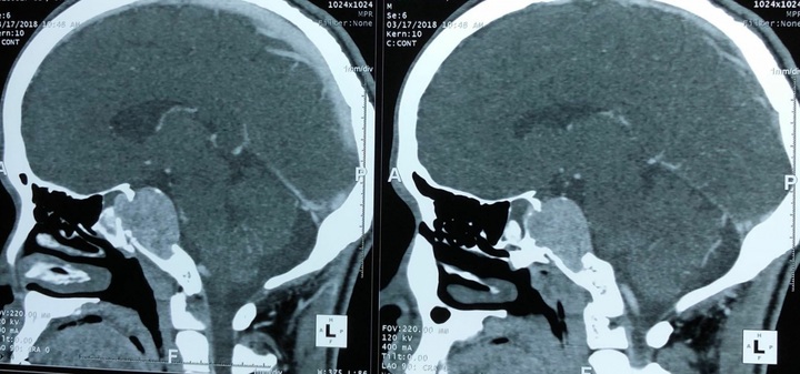 Quyết định sinh tử bóc khối u trong não