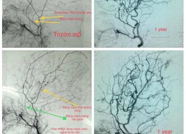 Trẻ bị đau đầu kéo dài có thể mắc bệnh Moyamoya