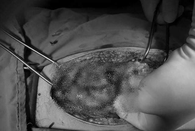 Cấp cứu kịp thời cho bệnh nhân bị đâm thấu ngực, thấu bụng