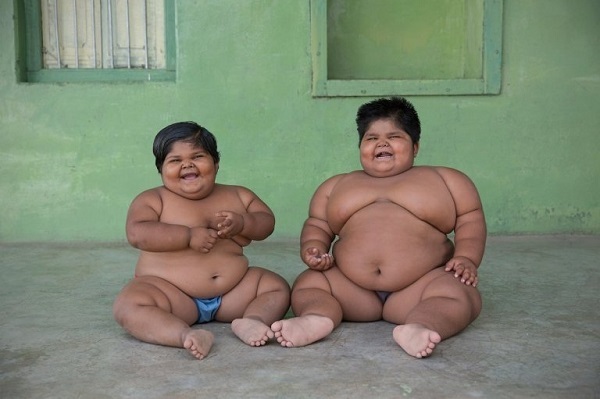 Hai chị em béo phì phải cắt bớt dạ dày để giảm cân