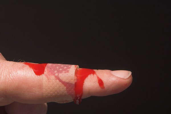 Những bệnh nhân được bảo hiểm chi trả hàng tỷ đồng