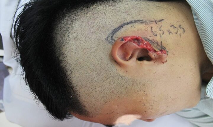 Bị cắn đứt vành tai bên trái khi đang nhậu với bạn