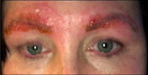 Làm đẹp lông mày: Chẳng ngờ bị nhiễm trùng, suýt tử vong