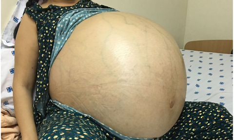 Người phụ nữ sống chung với khối u lớn nhất Việt Nam được phẫu thuật thành công