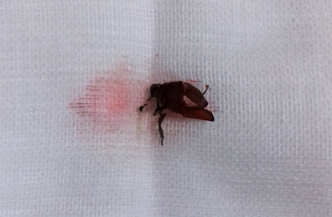 Bé trai 9 tuổi suýt thủng màng nhĩ chỉ vì bị bọ cánh cứng chui vào tai lúc ngủ