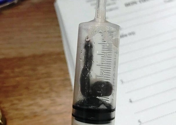 Kinh hãi gắp 2 con vắt dài sống trong mũi 2 bệnh nhân gần một tháng