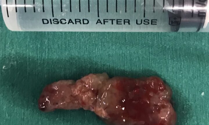 Mới 28 tuổi đã đau lưng, yếu chân, không ngờ bị u tủy sống