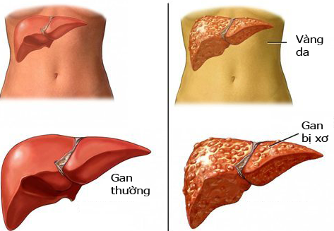 PGS.TS Trịnh Thị Ngọc  "mách nước " cách bảo vệ lá gan bị tổn thương