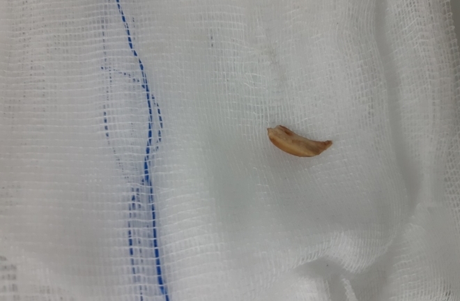 Cấp cứu cụ già 84 tuổi suy hô hấp vì hóc hạt sen trong bát cháo tổ yến