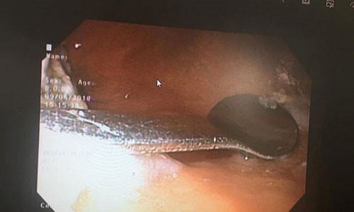 Hy hữu: Đi uống cà phê, cô gái nuốt luôn cả thìa sắt