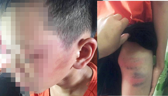 Điều tra vụ bé trai 12 tuổi tố bị mẹ kế đánh đập phải nhập viện