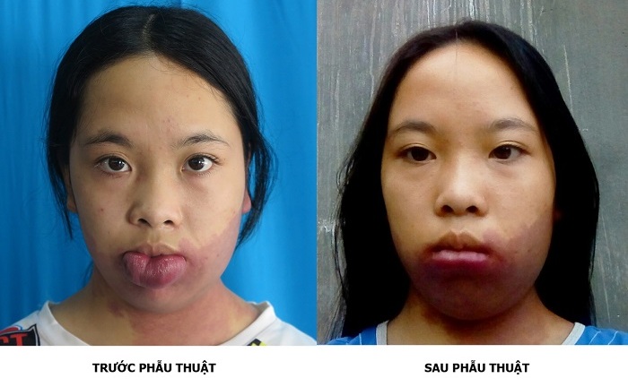 Hành trình 16 năm tìm lại nụ cười của bạn học sinh nghèo dị tật bẩm sinh