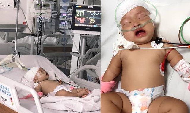 Bé gái 14 tháng tuổi bất ngờ bị khỉ nhà hàng xóm tấn công rách đầu, lún hộp sọ