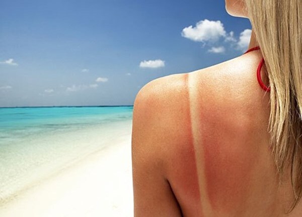 Bí quyết hồi phục hiệu quả tổn thương da do nắng