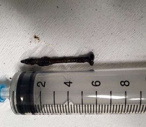 Bị cây đinh gỉ văng vào phổi, người đàn ông liên tục ho ra máu