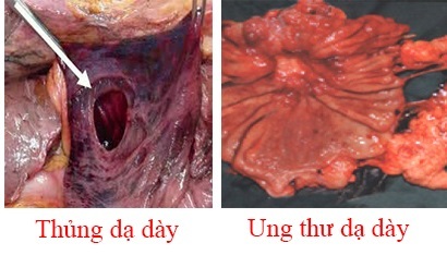 Nhầm lẫn tai hại bệnh nhân dạ dày thường mắc phải khi dùng Nano Curcumin