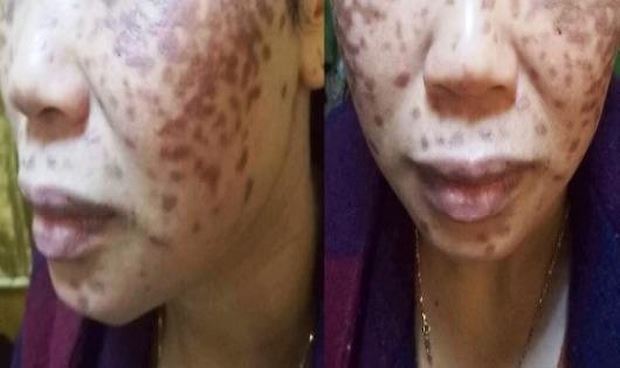 Kinh dị chuyện làm đẹp từ....axit