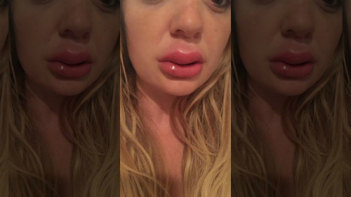 Tin tức đời sống mới nhất ngày 28/7/2018: Đôi môi như mỏ vịt của cô gái tiêm filler giá rẻ