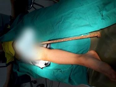 Nhảy từ tường bao xuống, bé trai bị thanh sắt dài 60cm đâm xuyên cơ thể