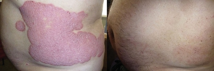 Điều trị bệnh vẩy nến hiệu quả bằng thảo dược