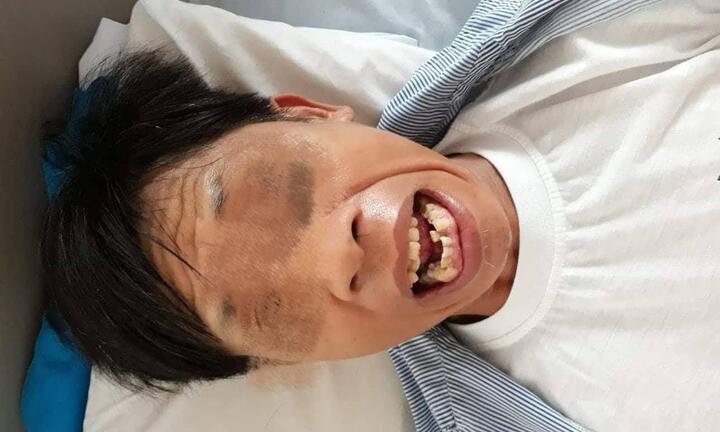 Dằm tre đâm vào tay, chủ quan nên hàm cứng đơ