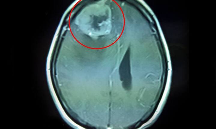 Đau đầu, yếu nửa người cẩn thận u não nguy hiểm chết người