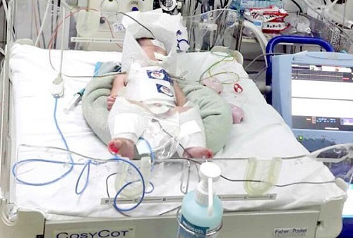 Bác sĩ 3 bệnh viện phối hợp cứu sống bé sơ sinh tổn thương não do mẹ vỡ gan trong lúc chuyển dạ