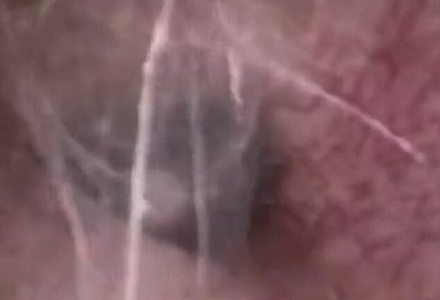 Sốc trước cảnh nhện giăng tơ bắt mồi trong tai người